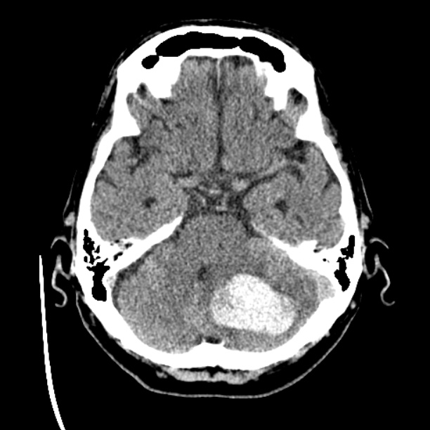 Cerebellar hemorrhage (Radiopaedia 27193-27359 Axial non-contrast 14).jpg