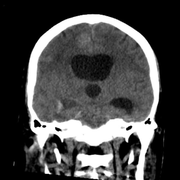 Cerebellar hemorrhage causing obstructive hydrocephalus (Radiopaedia 33989-35207 Coronal non-contrast 28).jpg