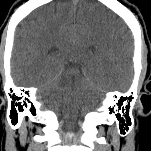 File:Cerebellar infarction (Radiopaedia 16625-16327 Coronal non-contrast 20).jpg