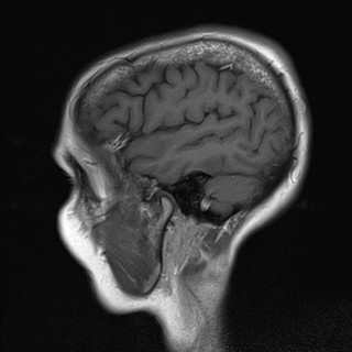 File:Cerebellar metastases (Radiopaedia 24038-24249 Sagittal T1 1).jpg