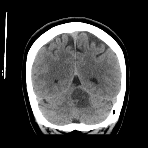 File:Cerebellar metastasis (cystic appearance) (Radiopaedia 41395-44258 Coronal non-contrast 46).png