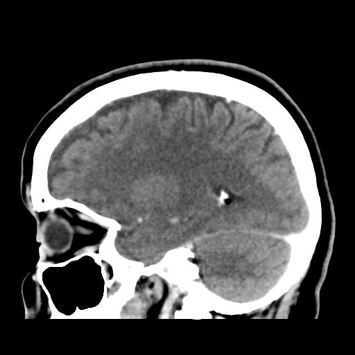 Cerebellar metastasis (cystic appearance) (Radiopaedia 41395-44258 F 19).png