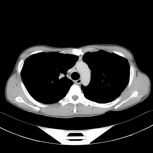 Cerebellar metastasis - adenocarcinoma lung (Radiopaedia 63184-71717 Axial C+ delayed 23).png