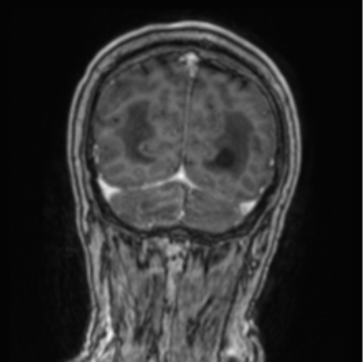Cerebellar metastasis from lung adenocarcinoma (Radiopaedia 86690-102829 Coronal T1 C+ 20).png