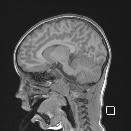 Cerebellar stroke (Radiopaedia 32202-33150 Sagittal T1 C+ 30).png