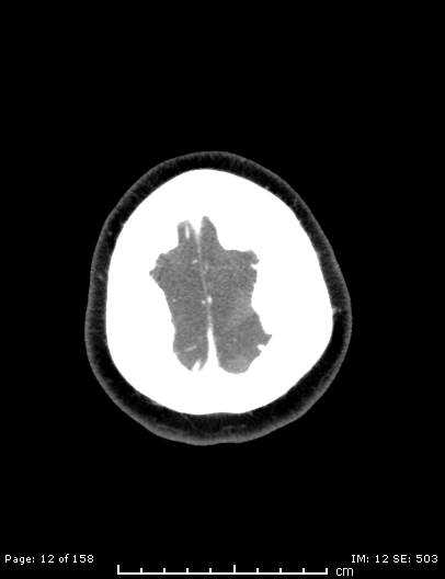 Cerebellar strokes due to intracranial giant cell arteritis (Radiopaedia 68799-78510 CT angiogram 12).jpg