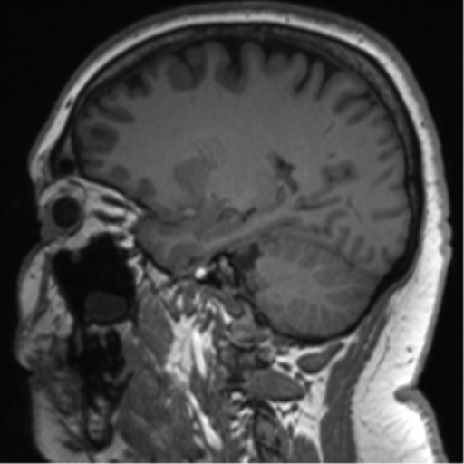 Cerebellopontine angle meningioma (Radiopaedia 48434-53348 Sagittal T1 58).png