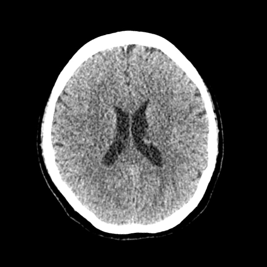 File:Cerebellopontine angle meningioma (Radiopaedia 53561-59592 Axial non-contrast 41).jpg