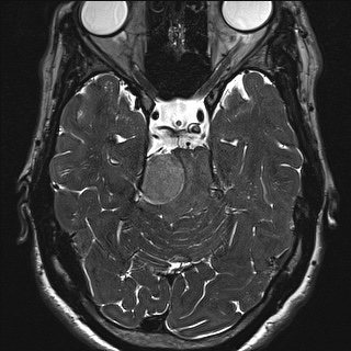 Cerebellopontine angle meningioma (Radiopaedia 72983-83680 Axial FIESTA 53).jpg