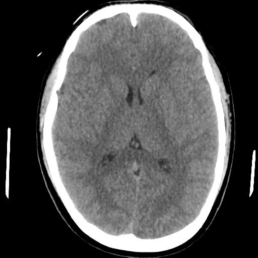 Cerebral abscess (Radiopaedia 29451-29919 Axial non-contrast 26).jpg