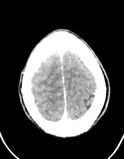 Cerebral abscess (Radiopaedia 60342-68008 Axial C+ delayed 44).png