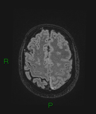 Cerebral abscess and subdural empyema (Radiopaedia 84436-99779 Axial FLAIR 24).jpg
