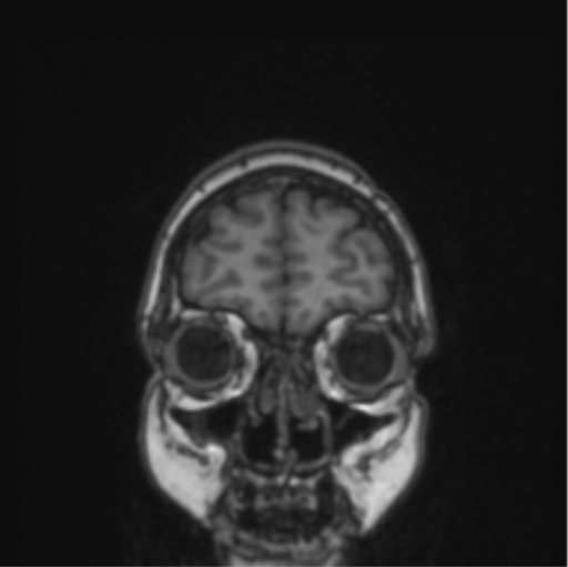 Cerebral abscess from pulmonary arteriovenous malformation (Radiopaedia 86275-102291 Coronal T1 78).png