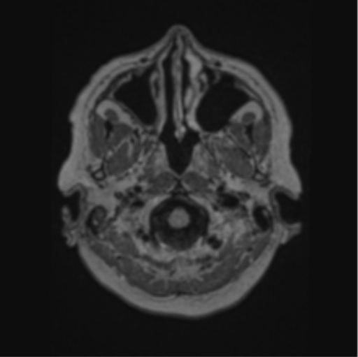 Cerebral abscess from pulmonary arteriovenous malformation (Radiopaedia 86275-102291 J 10).png