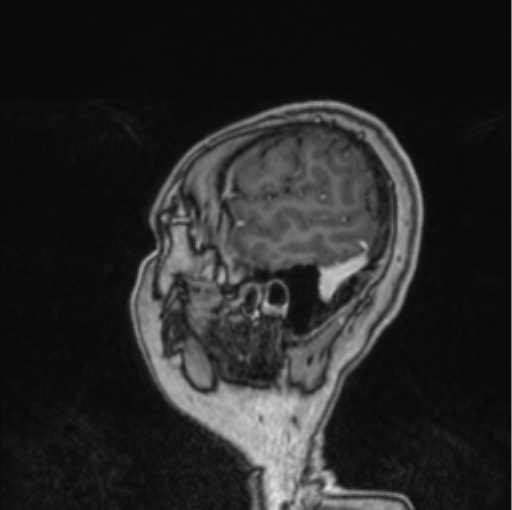 Cerebral abscess from pulmonary arteriovenous malformation (Radiopaedia 86275-102291 Sagittal T1 C+ 12).png