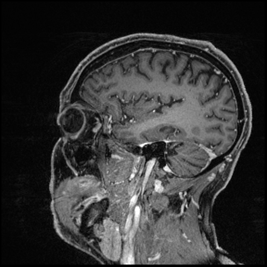 Cerebral abscess with ventriculitis (Radiopaedia 78965-91878 Sagittal T1 C+ 133).jpg