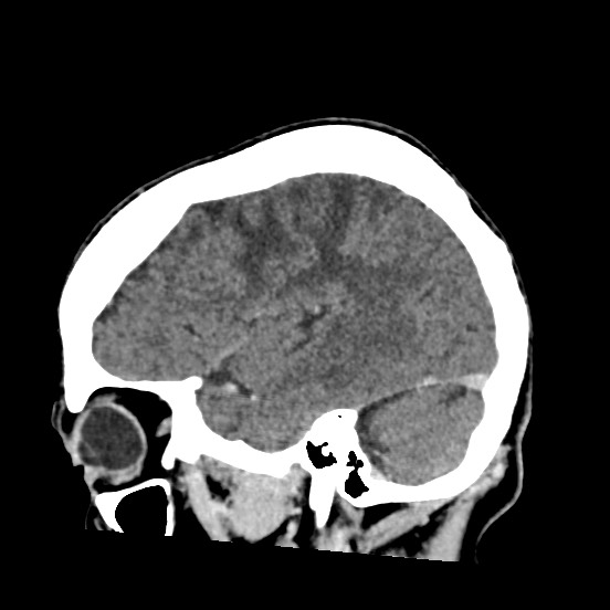 Cerebral amyloid angiopathy-related inflammation (Radiopaedia 74836-85848 C 16).jpg