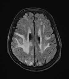 File:Cerebral amyloid angiopathy-related inflammation (Radiopaedia 74836-85849 Axial FLAIR 20).jpg