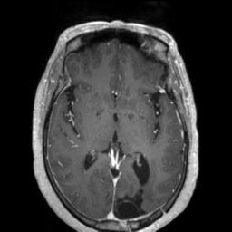 Cerebral amyloid angiopathy (Radiopaedia 29129-29518 Axial T1 C+ 75).jpg