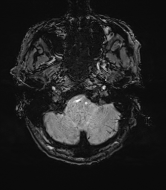 File:Cerebral amyloid angiopathy (Radiopaedia 46082-50433 Axial SWI 10).png