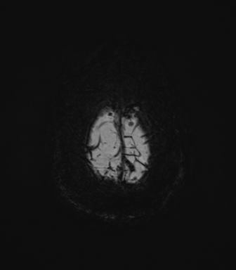 Cerebral amyloid angiopathy (Radiopaedia 46082-50433 Axial SWI MIP 76).png