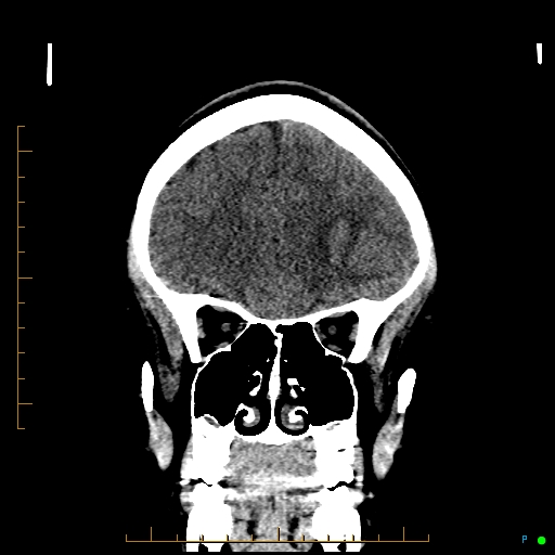 File:Cerebral arteriovenous malformation (AVM) (Radiopaedia 78162-90706 Coronal non-contrast 28).jpg