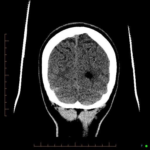 Cerebral arteriovenous malformation (AVM) (Radiopaedia 78162-90706 Coronal non-contrast 85).jpg