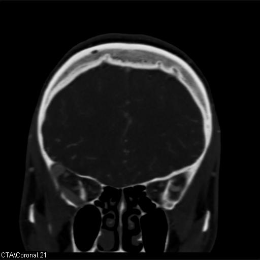 File:Cerebral arteriovenous malformation (Radiopaedia 28518-28759 C 21).jpg