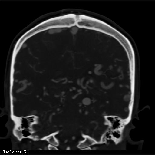 Cerebral arteriovenous malformation (Radiopaedia 28518-28759 C 51).jpg