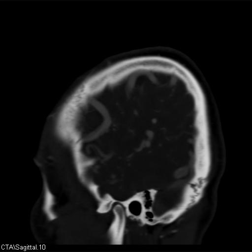 Cerebral arteriovenous malformation (Radiopaedia 28518-28759 D 7).jpg