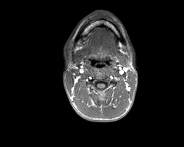 Cerebral arteriovenous malformation (Radiopaedia 30198-30813 Axial T1 65).jpg