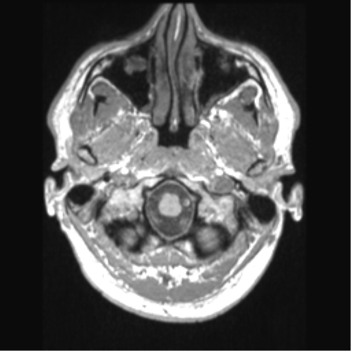 File:Cerebral arteriovenous malformation (Radiopaedia 39259-41506 Axial T1 10).png