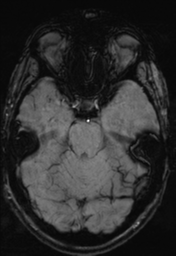 File:Cerebral arteriovenous malformation (Radiopaedia 55798-62372 Axial SWI 13).png
