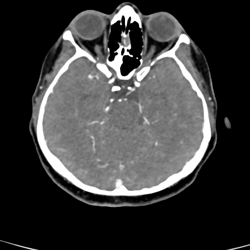 Cerebral arteriovenous malformation (Radiopaedia 73830-84645 B 64).jpg