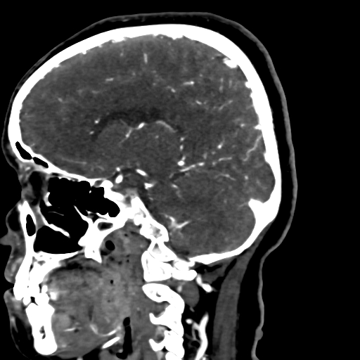 Cerebral arteriovenous malformation (Radiopaedia 73830-84645 Sagittal C+ delayed 38).jpg