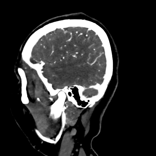 Cerebral arteriovenous malformation (Radiopaedia 73830-84645 Sagittal C+ delayed 76).jpg