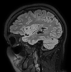 Cerebral arteriovenous malformation (Radiopaedia 74411-85654 Sagittal FLAIR 30).jpg