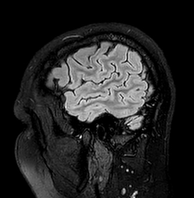 File:Cerebral arteriovenous malformation (Radiopaedia 74411-85746 Sagittal FLAIR 12).jpg