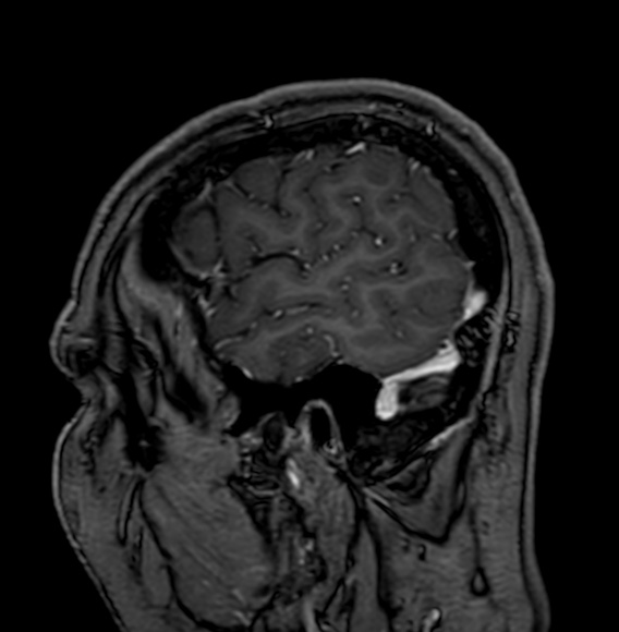 Cerebral arteriovenous malformation (Radiopaedia 74411-85746 Sagittal T1 C+ 12).jpg