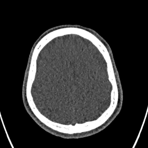 Cerebral arteriovenous malformation (Radiopaedia 78188-90746 Axial non-contrast 143).jpg