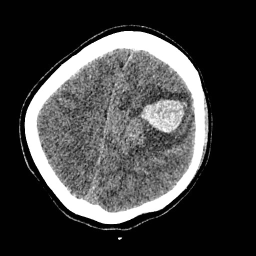 Cerebral arteriovenous malformation (Radiopaedia 79677-92887 Axial non-contrast 32).jpg