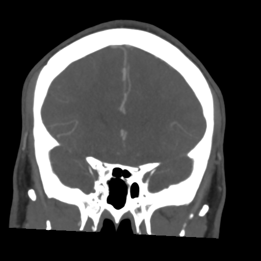 File:Cerebral arteriovenous malformation (Spetzler-Martin grade 2) (Radiopaedia 41262-44076 F 22).png