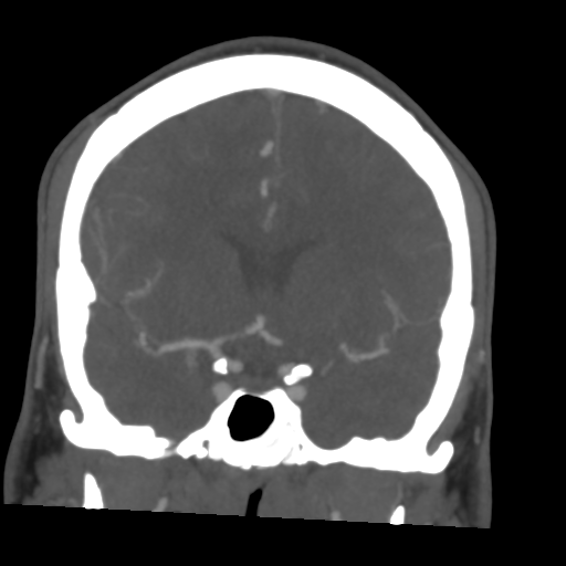 Cerebral arteriovenous malformation (Spetzler-Martin grade 2) (Radiopaedia 41262-44076 F 26).png