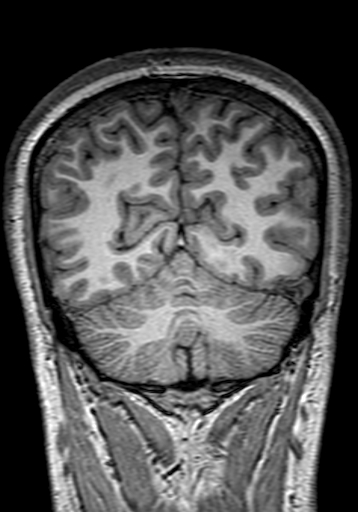 Cerebral arteriovenous malformation at posterior body of corpus callosum (Radiopaedia 74111-84925 Coronal T1 270).jpg