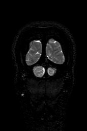 Cerebral arteriovenous malformation at posterior body of corpus callosum (Radiopaedia 74111-84925 Coronal T2 169).jpg
