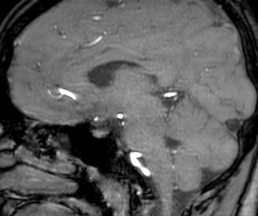 Cerebral arteriovenous malformation at posterior body of corpus callosum (Radiopaedia 74111-84925 J 210).jpg