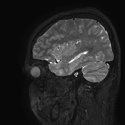 Cerebral arteriovenous malformation at posterior body of corpus callosum (Radiopaedia 74111-84925 Sagittal T2 28).jpg