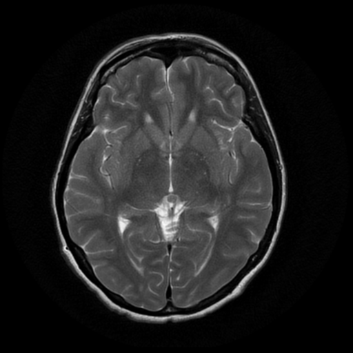 File:Cerebral autosomal dominant arteriopathy with subcortical infarcts and leukoencephalopathy (CADASIL) (Radiopaedia 41018-43763 Ax T2 PROP 10).png