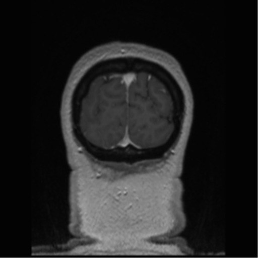 Cerebral cavernoma and development venous anomaly (Radiopaedia 37603-39482 Coronal T1 C+ 9).png
