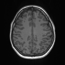 Cerebral cavernous venous malformation (Radiopaedia 70008-80021 Axial T1 55).jpg